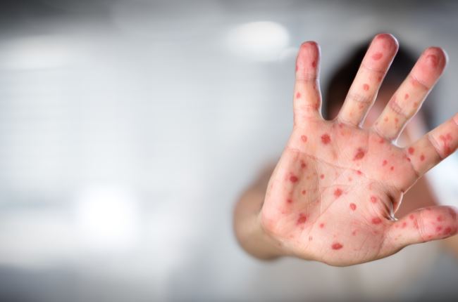 Measles makes the patient as fragile as a newborn