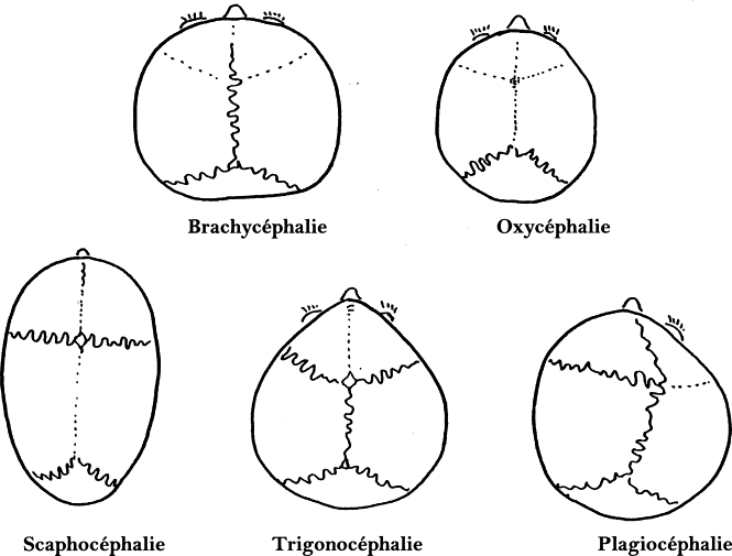 Main forms of craniostenosis. Abnormally closed sutures are shown in dotted lines. © P. Dhellemmes et al, French Annals of Anesthesia and Resuscitation, 2002